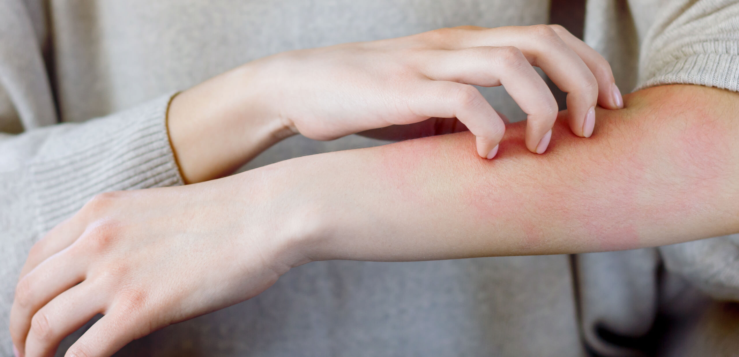 アレルギー系の症状